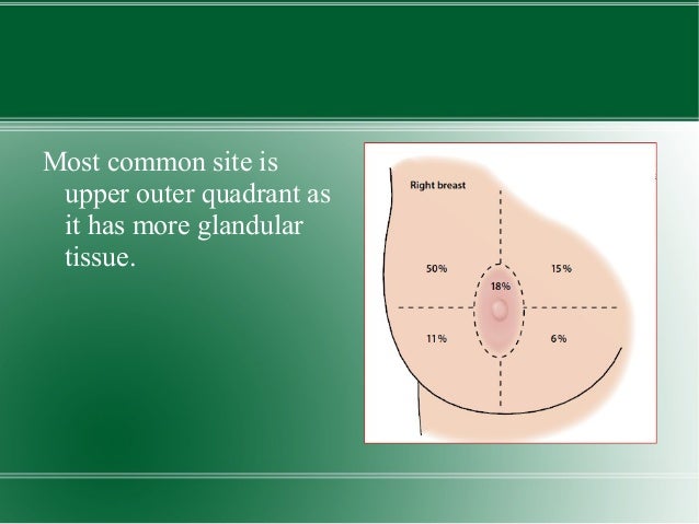 breast cancer quadrant incidence Nude merilin monroe